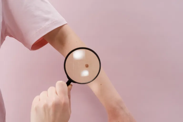 Vyšetření znamének: Proč, kdy a kam zajít a kolik to stojí?